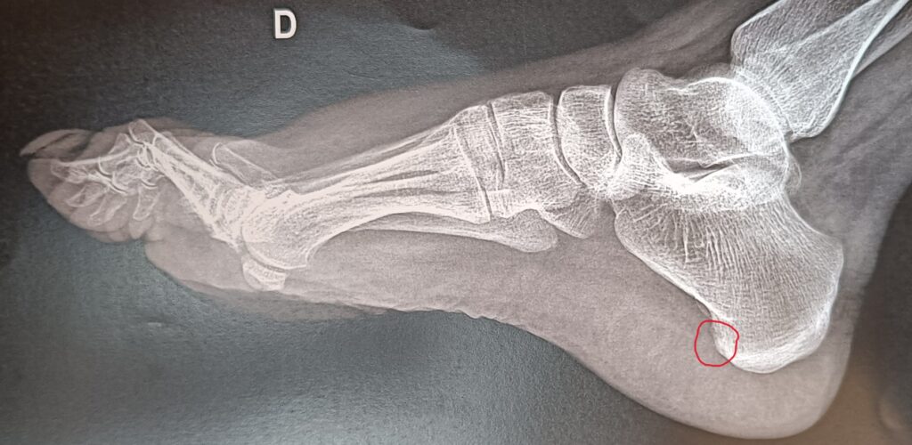radiographie pied sain