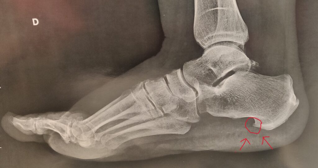 radiographie pied épine calcanéenne