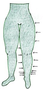 collant de compression classe 3 lipodème