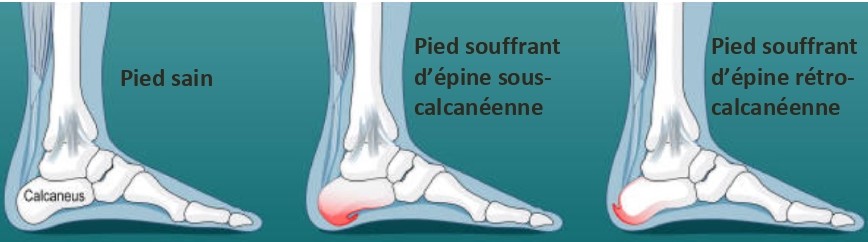 dessin pied sain, pied avec épine calcanéenne