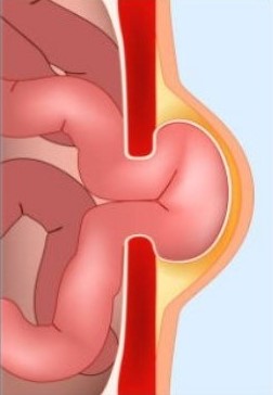 dessin hernie/éventration