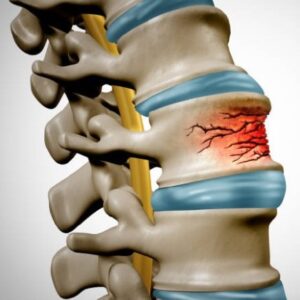 dessin colonne vertébrale tassement plateau vertébral