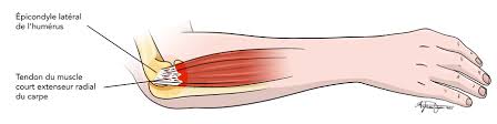 image myologie coude epicondylite