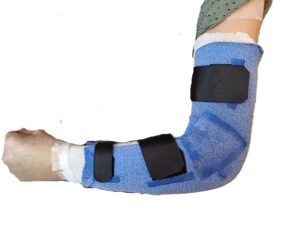 Attelle de coude thermoformée - Protection post-opératoire