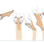 tuto enfilage compression veineuse