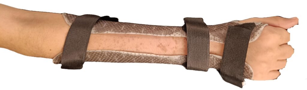 attelle de main/poignet/avant-bras thermoformée
