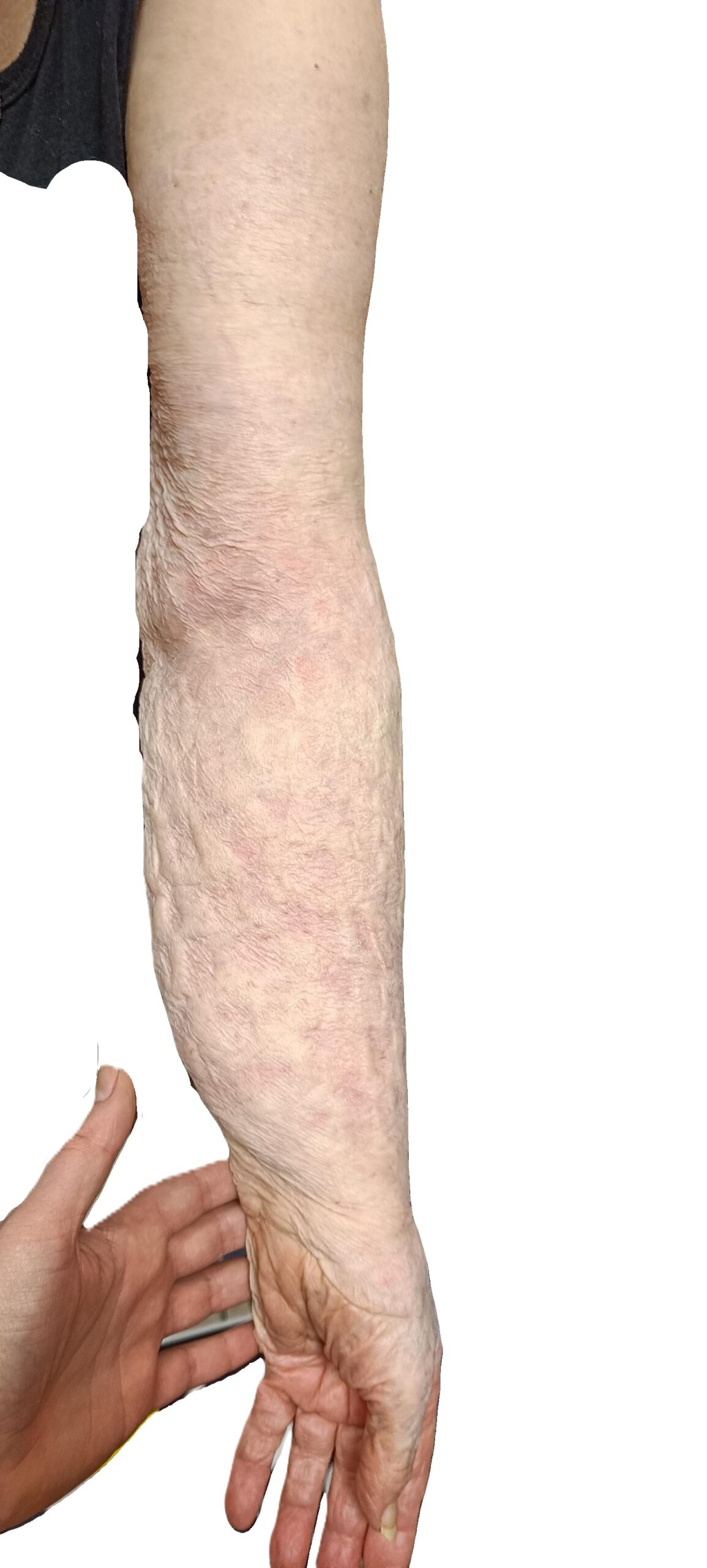 effet vêtement mobilisateur THUASNE MOBIDERM