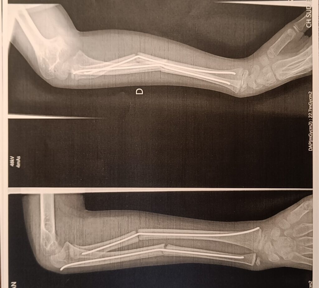 radio double fracture avant-bras
