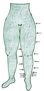 collant de compression classe 3 lipodème